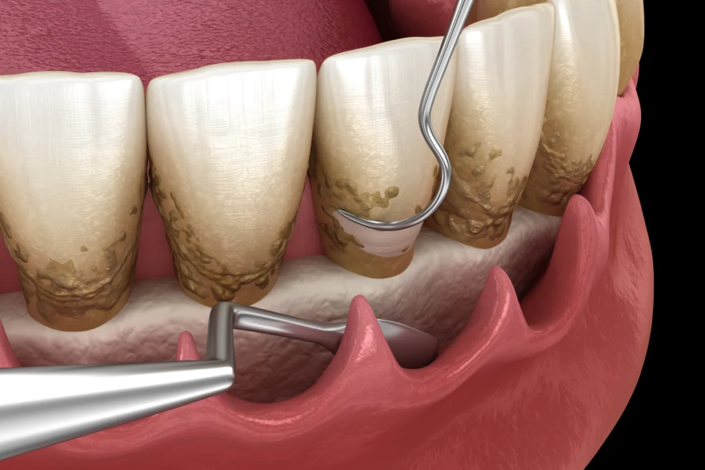 chirurgie assainissement parodontal Soins chirurgicaux des gencives Cabinet dentaire ESTIA - Chirurgiens-dentistes près de Lyon