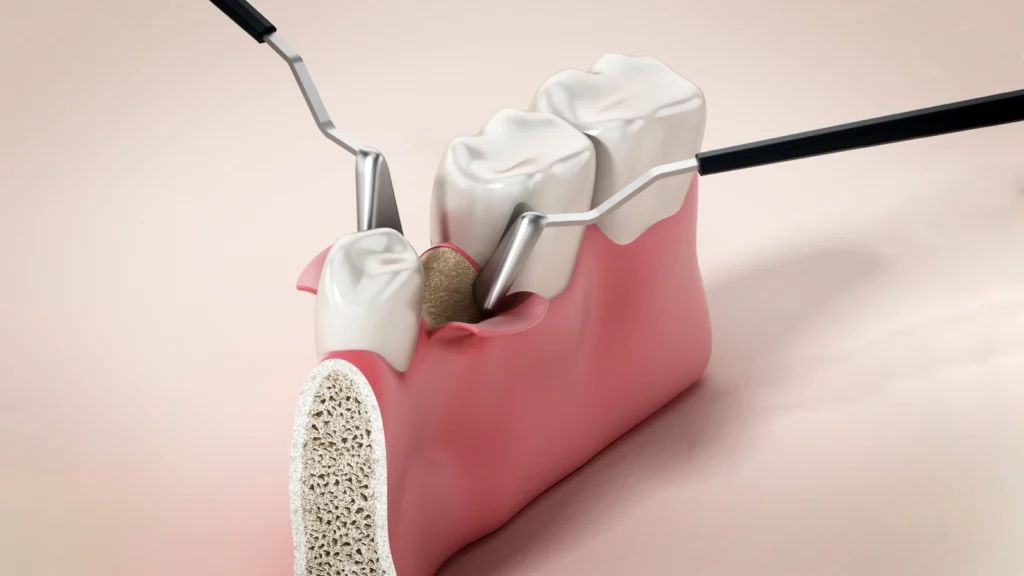 chirurgie orale Chirurgie orale Cabinet dentaire ESTIA - Chirurgiens-dentistes près de Lyon