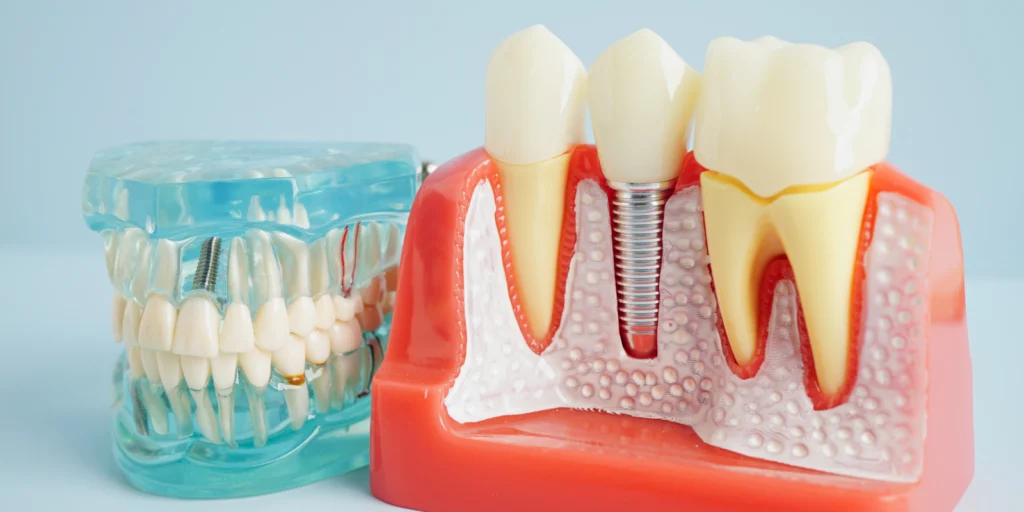 implant dentaire implant dentaire Implant dentaire Cabinet dentaire ESTIA - Chirurgiens-dentistes près de Lyon