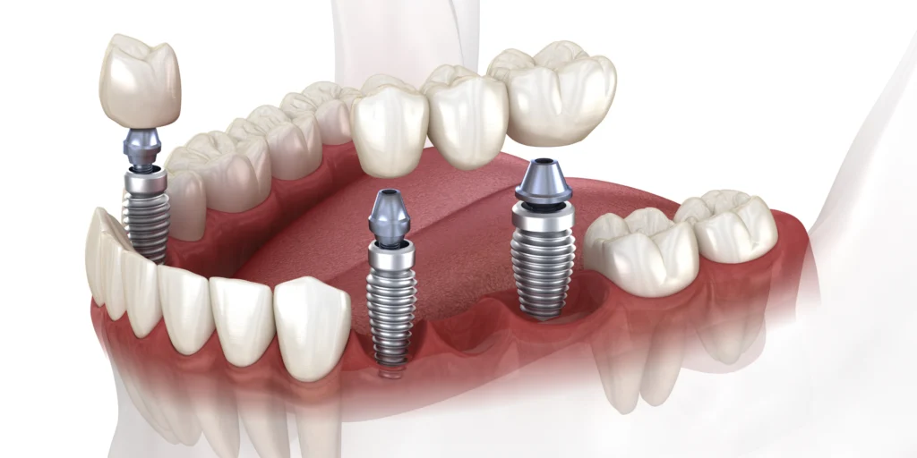 implant dentaire bridge implant dentaire bridge Implant dentaire Cabinet dentaire ESTIA - Chirurgiens-dentistes près de Lyon