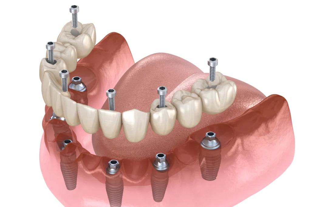 implant dentaire complet dentier implant dentaire complet dentier Implant dentaire Cabinet dentaire ESTIA - Chirurgiens-dentistes près de Lyon