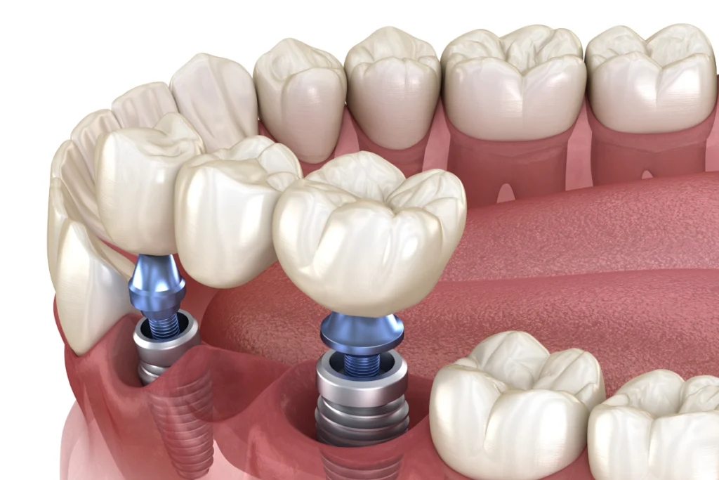 implant dentaire couronne bridge Couronnes & bridges sur implants Cabinet dentaire ESTIA - Chirurgiens-dentistes près de Lyon