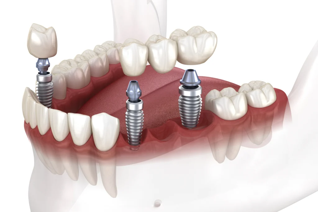 Implant dentaire