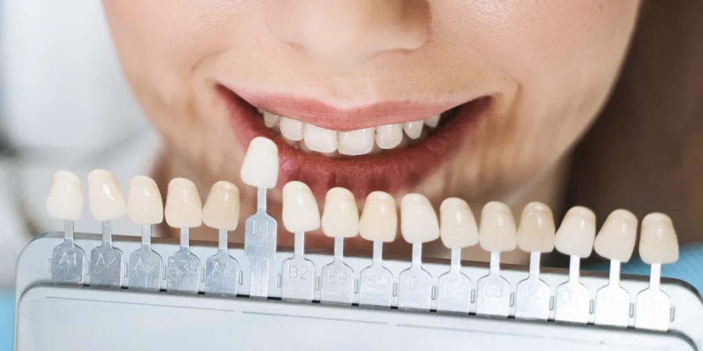 facettes dentaires veneers Facettes dentaires Cabinet dentaire ESTIA - Chirurgiens-dentistes près de Lyon