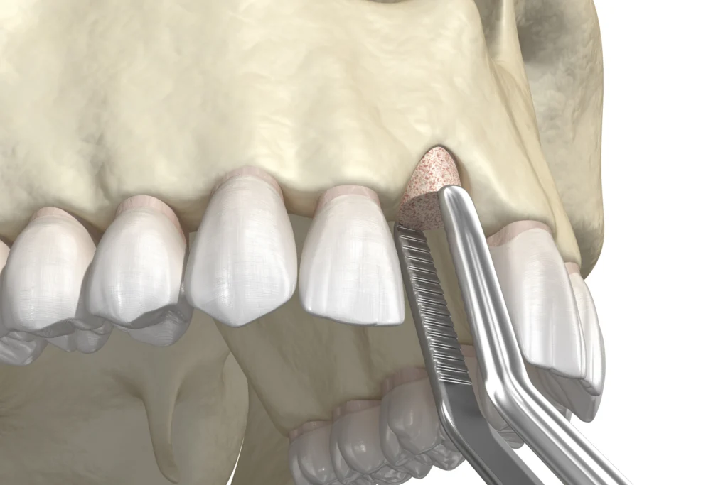 greffe osseuse chirurgie orale Greffes osseuses Cabinet dentaire ESTIA - Chirurgiens-dentistes près de Lyon